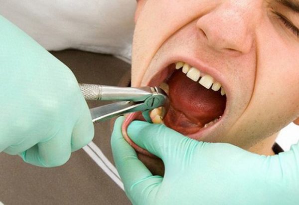 Nhổ răng khôn chảy máu bao lâu?