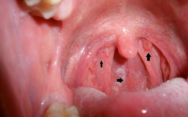 phòng khám bệnh tai mũi họng giúp phát hiện sớm bệnh ung thư vòm họng tại Thu Cúc