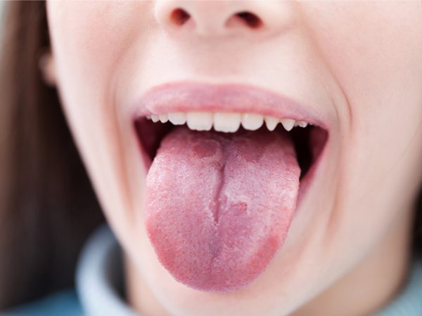 Biểu hiện của ung thư lưỡi giai đoạn đầu, cách điều trị