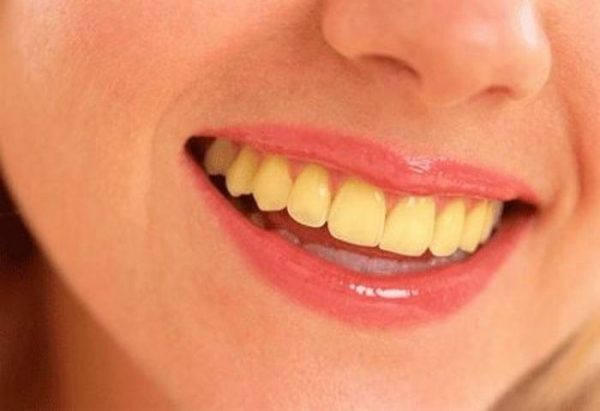 Có nhiều nguyên nhân dẫn đến hàm răng của bạn bị xỉn màu