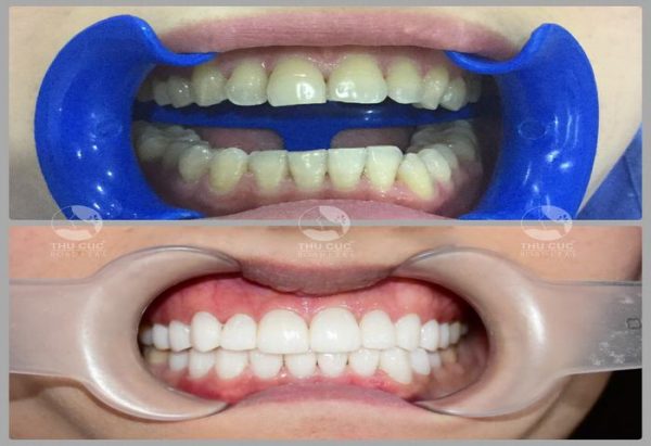 răng thẩm mỹ ở đâu tốt tại Hà Nội?