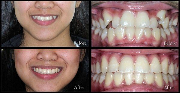 nắn chỉnh răng khểnh Thu Cúc