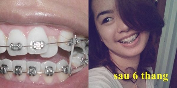 nắn chỉnh răng khểnh