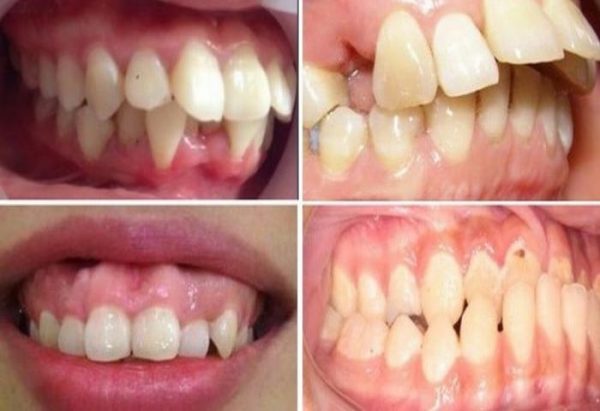 Chỉnh hình răng hô một lần duy nhất với phương pháp niềng răng