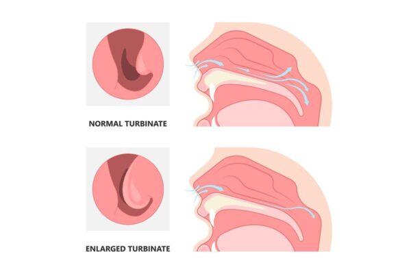 Phù nề niêm mạc mũi là tình trạng mũi bị tổn thương hoặc viêm nhiễm