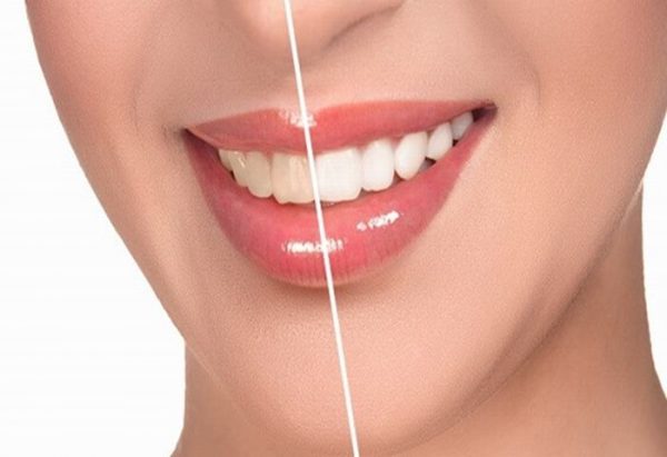 Tẩy trắng răng Bleach Bright là gì? Hiệu quả ra sao?