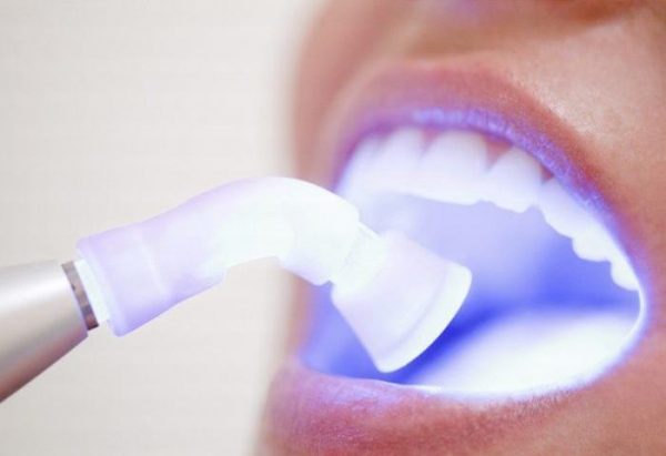 Tẩy trắng răng Plasma có hại không? | TCI Hospital