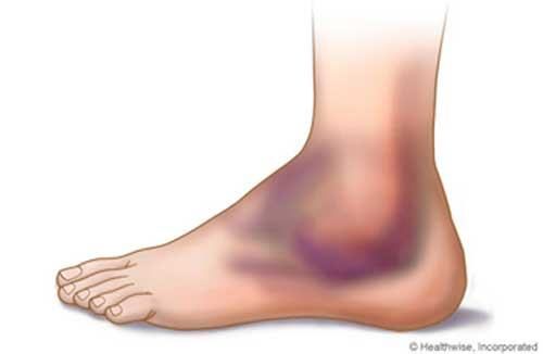 giãn dây chằng cổ chân Triệu chứng giãn dây chằng cổ chân