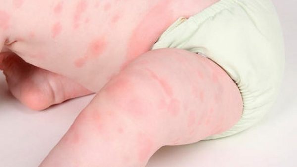 phòng bệnh cho bé vào mùa mưa