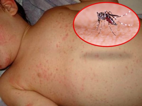 phòng bệnh cho trẻ em vào mùa mưa