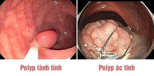 polyp đại tràng ác tính dễ gây ung thư đại tràng 