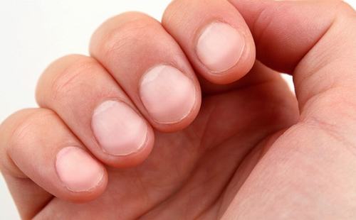 Ngón tay DÙI TRỐNG - Căn bệnh nguy hiểm mà nhiều người KHÔNG biết Ngón tay dùi trống là biểu hiện bệnh lý của nhiều vấn đề sức khỏe