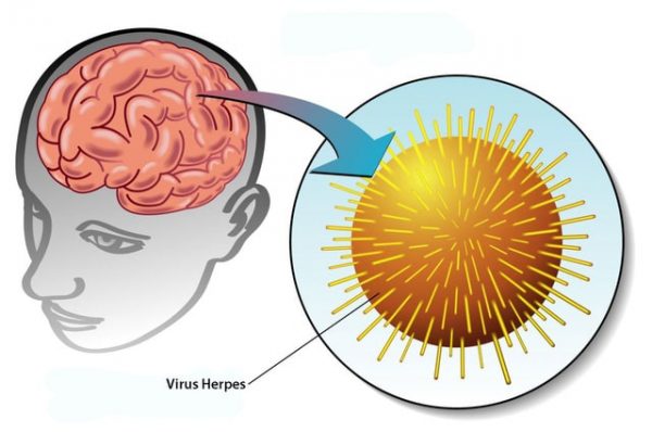 virus herpes có thể biến chứng gây bệnh viêm não