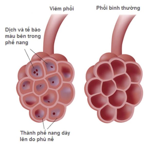 dấu hiệu trẻ bị viêm phổi