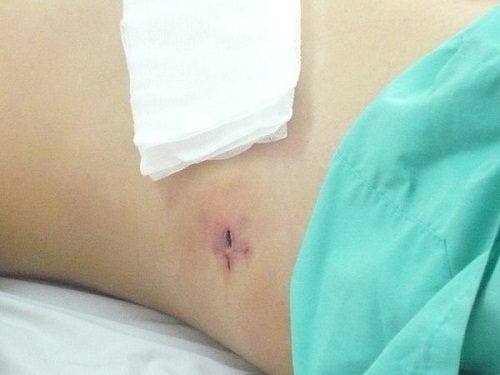 Mổ ruột thừa sau bao lâu đi làm được là một câu hỏi mà rất nhiều người quan tâm
