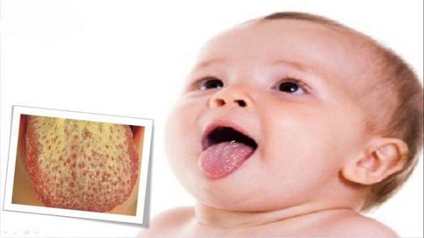 Nấm miệng ở trẻ sơ sinh biểu hiện chủ yếu trên bề mặt lưỡi với những mảng bám có màu trắng lâu ngày chuyển sang màu vàng. 