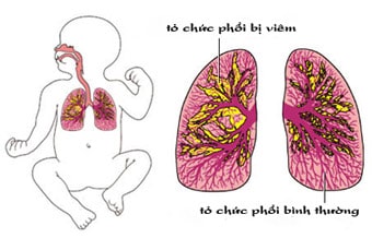 viêm phổi ở trẻ sơ sinh