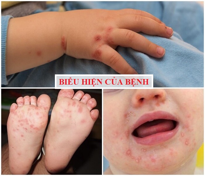 biểu hiện của bệnh tay chân miệng ở trẻ em