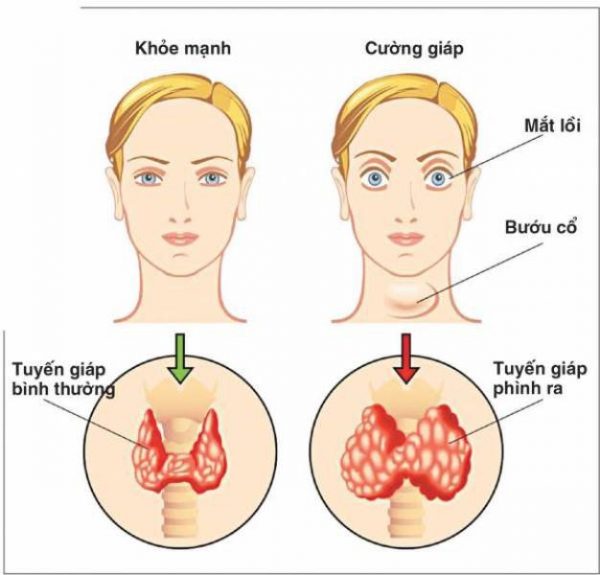 biểu hiện của bệnh cường giáp 