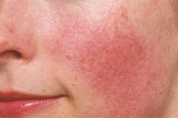 Biểu hiện da mặt bị đỏ rát và ngứa