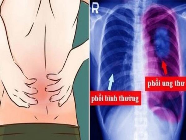 triệu chứng đau lưng ở vùng phía sau phổi có thể do bệnh ung thư phổi gây ra