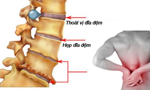 Đau thắt lưng là biểu hiện của bệnh thoát vị đĩa đệm (ảnh minh họa)