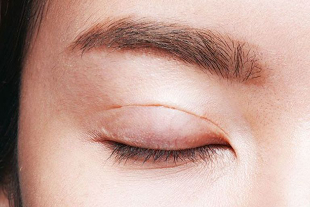 Mí mắt bị ngứa và sưng