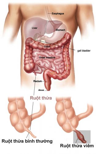 Mổ ruột thừa mấy ngày hết đau và cần phải lưu ý gì? 1