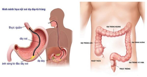 nội soi dạ dày có đau không