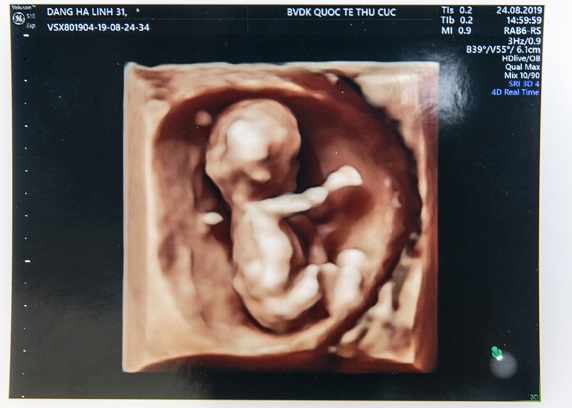 Khám phá siêu âm thai 5D đẳng cấp và chuyên nghiệp. Với việc sử dụng công nghệ cao cấp, bạn sẽ được trải nghiệm những hình ảnh sinh động và chi tiết nhất về sức khỏe và tình trạng phát triển của con yêu trong bụng mẹ.