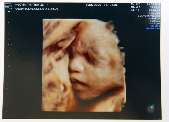 Siêu âm 5D: Với công nghệ siêu âm 5D, bạn sẽ nhìn thấy thế giới của bé trong bụng mẹ một cách rõ nét và sống động. Hãy xem hình ảnh để cảm nhận vẻ đẹp tuyệt vời của thai nhi và mang lại niềm vui và hạnh phúc cho cả gia đình.