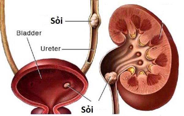 emNhững viên sỏi có kích thước lớn và nhiều góc cạnh có thể kẹt lại niệu quản và gây ra nhiều biến chứng nguy hiểm cho người bệnh (ảnh minh họa)/em