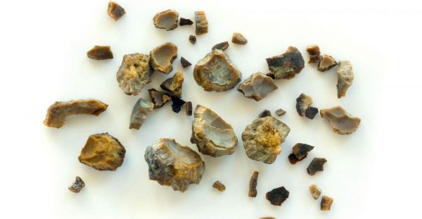 Phân loại sỏi tiết niệu