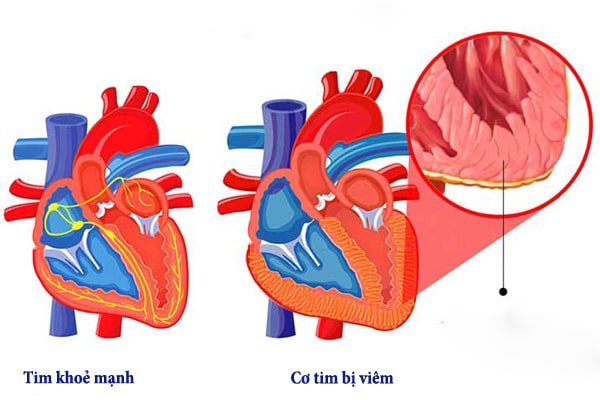 bệnh viêm cơ tim có lây không