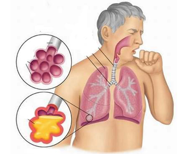nhiễm khuẩn đường đường hô hấp có thể nổi hạch ở cổ