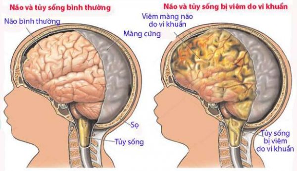 viêm màng não ở trẻ em là gì