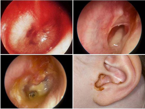 Bệnh cảm lạnh nếu không được điều trị có thể gây biến chứng viêm tai.
