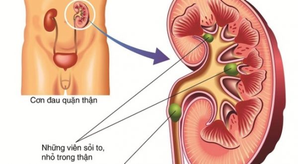 Bị viêm đường tiết niệu do nguyên nhân nào