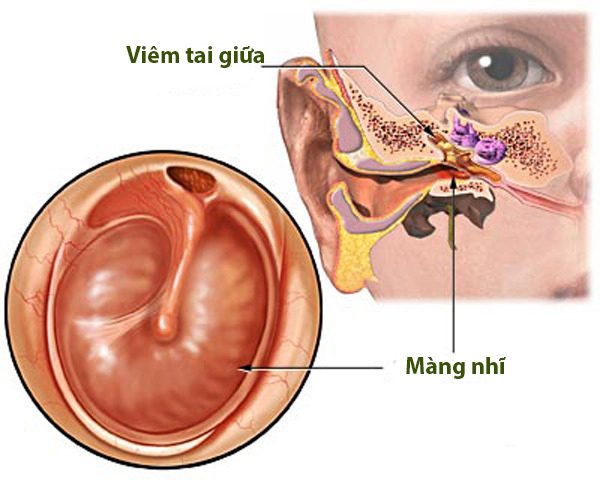 Trẻ em bị viêm tai giữa kiêng ăn gì? Hướng dẫn chi tiết cho bố mẹ