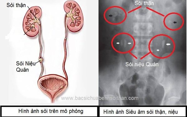 Sỏi niệu quản là gì