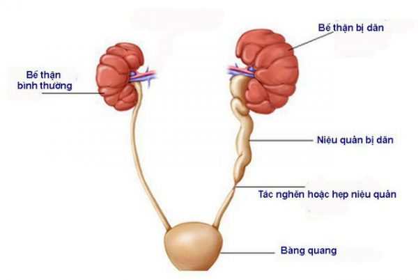 Những biến chứng nguy hiểm từ sỏi niệu quản