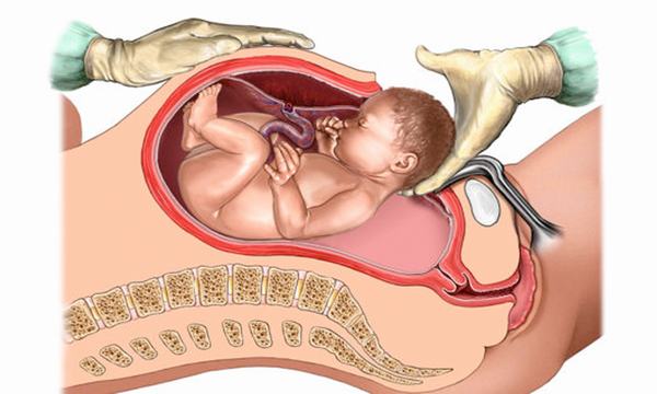 Với nữ giới có xương chậu hẹp cần phải mổ lấy thai