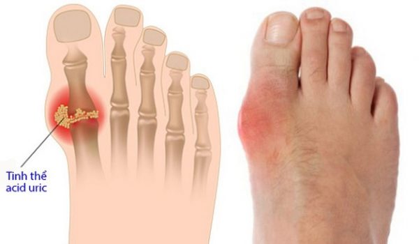 đau nhức mu bàn chân do bệnh lý