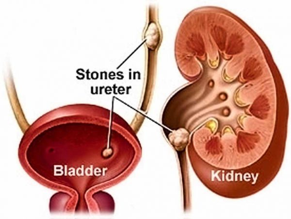 Đau sỏi thận do đâu