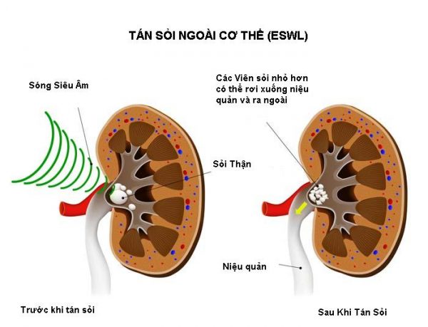 Tán sỏi ngoài cơ thể diễn ra như thế nào