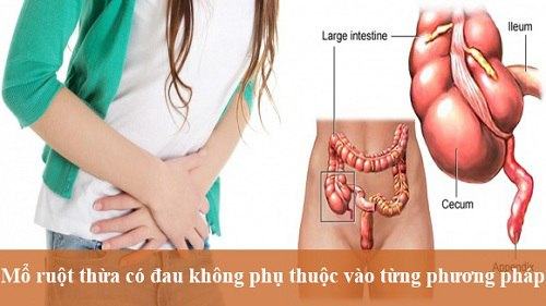đau ruột thừa mổ có đau không