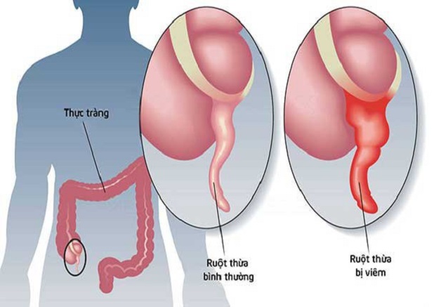 mổ ruột thừa xong bị sốt