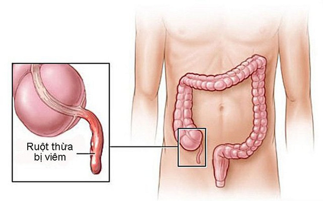 lý do mổ ruột thừa xong bị sốt
