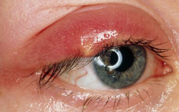 Viêm bờ mi mắt chủ yếu là do vi khuẩn gây ra và nếu không được điều trị hiệu quả có thể gây nhiễm trùng sẽ rất nguy hiểm. (ảnh minh họa)
