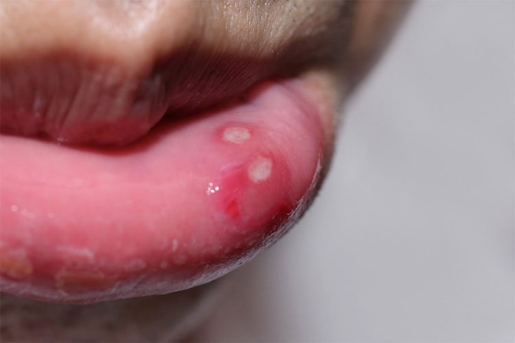 Nhiệt miệng gây đau rát và khó khăn trong ăn uống và nói chuyện